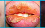 Воспаление губ (кожная болезнь) — заболевание с характерным высыпанием сгруппированных пузырьков на коже и слизистых, все о гомеопатии