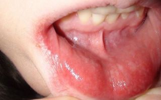 Белое пятно на внутренней стороне губы — причины и лечение, все о гомеопатии
