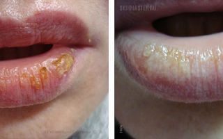 Белые губы — главный признак различных заболеваний, все о гомеопатии