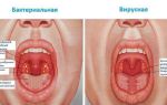 Ангина (от лат. tonsillae — миндалины) — инфекционное заболевание с местными проявлениями, все о гомеопатии