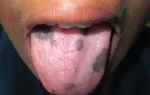 Черные пятна на языке — основные причины возникновения, все о гомеопатии