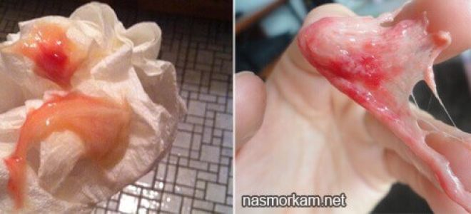 Гной с кровью из носа — что это означает, все о гомеопатии