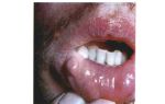 Воспаление слизистой оболочки рта — что делать, все о гомеопатии