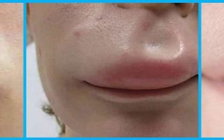 Опухла губа — от чего может возникнуть это явление, все о гомеопатии