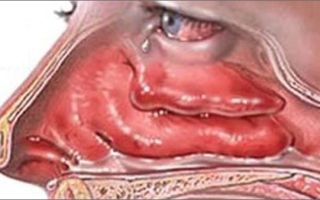 Прыщи вокруг рта — причины воспаления, все о гомеопатии