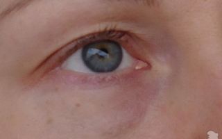 Синяки в уголках глаз у переносицы — все о гомеопатии