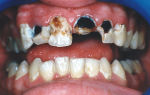 Крошатся зубы (у детей и взрослых) — самые частые причины, все о гомеопатии