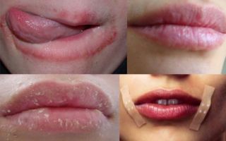 Шелушение губ — методы лечения и профилактики, все о гомеопатии