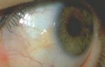 Желтые белки глаз — все методы терапии, все о гомеопатии