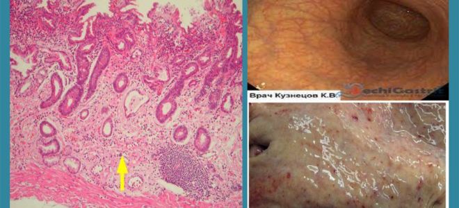 Гастрит (Gastritis) — воспалительно-дистрофические изменения слизистой оболочки желудка, все о гомеопатии: как правильно лечить и вовремя диагностировать