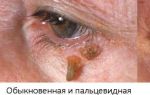 Бородавка на веке глаза — доброкачественное новообразование кожи, все о гомеопатии