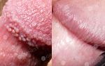 Белый налет на половых губах – причины появления, все о гомеопатии