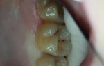 Болят зубы от сладкого — что делать и как лечить, все о гомеопатии