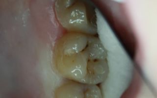 Болят зубы от сладкого — что делать и как лечить, все о гомеопатии
