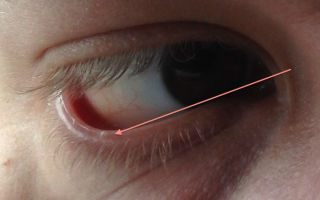 Бельмо на глазу (Лейкома) — васкуляризированное пятно, все о гомеопатии
