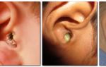Что значат гнойные выделения из ушей и как их лечить — источники проблемы, все о гомеопатии
