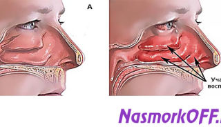 Жжение в носу при насморке — причины и терапия, все о гомеопатии