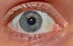 Красные сосуды в глазах — как их убрать, почему появляются, все о гомеопатии
