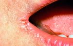 Болячки в уголках губ (заеды) — чем их лечить, все о гомеопатии