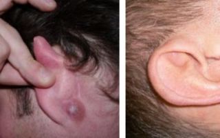 Почему в мочке уха появился шарик — что это и как лечить, все о гомеопатии