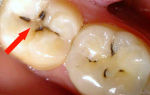 Черные полоски на зубах — безобидный дефект или патологические проблемы, все о гомеопатии
