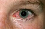 Конъюнктивит — воспаление слизистой оболочки глаза, все о гомеопатии