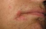 Шелушится кожа вокруг рта — особенности лечения, все о гомеопатии