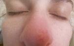 Красные пятна на носу — причины и лечение, все о гомеопатии