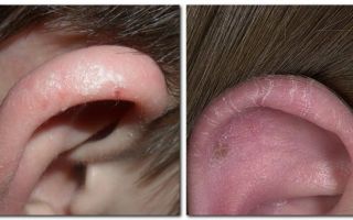 Почему шелушатся уши и как их лечить — как избавиться от ушной перхоти самостоятельно, все о гомеопатии