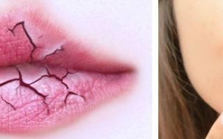 Жжение губ (горят губы) — почему возникает сухость, все о гомеопатии