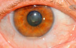 Блефарит (воспаление века) — хроническое воспаление краев глаз, все о гомеопатии