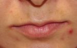 Покраснение в уголках губ — что делать, все о гомеопатии