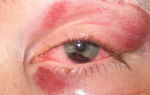 Красные пятна на веках глаз — причины и лечение, все о гомеопатии