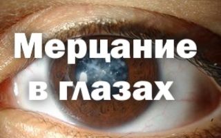 Мерцание в глазах — причины глазной мигрени, все о гомеопатии