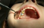 Гной в зубе — причины появления, все о гомеопатии