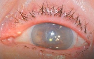 Туман в глазах — возможные заболевания, все о гомеопатии