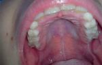 Воспаление нёба во рту — что является причиной болевых ощущений, все о гомеопатии