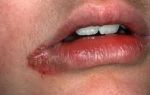 Трескаются губы — дискомфорт в повседневной жизни, все о гомеопатии