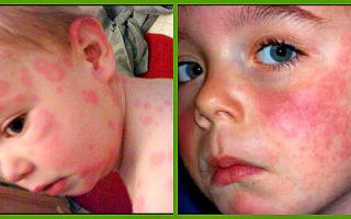 Причины появления аллергии на лице — вероятные причины развития, все о гомеопатии