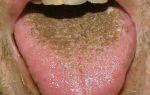 Черный налет на языке — на что обратить внимание, все о гомеопатии