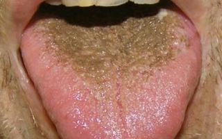 Черный налет на языке — на что обратить внимание, все о гомеопатии