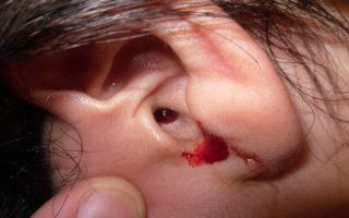 Почему идет кровь из ушей и что с этим делать — причины опасного симптома, все о гомеопатии