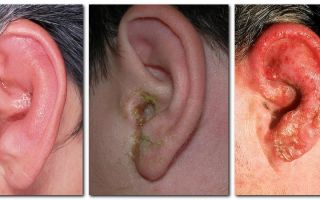 Что делать, если продуло ухо? — лечим воспалительный процесс, все о гомеопатии