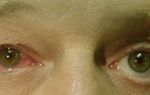 Резь и слезоточивость глаз — сигналы о проблемах органов зрения, все о гомеопатии