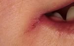Трещины в уголках губ — чем лечить «заеды», все о гомеопатии
