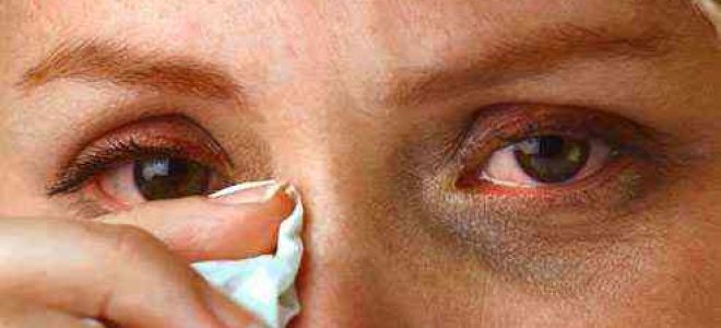 Боль в уголках глаз — выясняем причины, все о гомеопатии