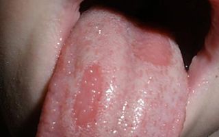 Воспаление сосочков на языке — способы устранения, все о гомеопатии