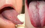 Воспаление языка (Glossitis) — воздействие патогенных микроорганизмов, все о гомеопатии