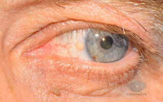 Желтые пятна на веках глаз — разберем все причины, все о гомеопатии