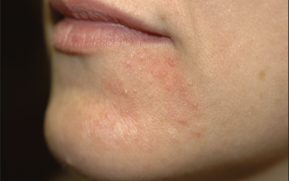 Сыпь вокруг рта (взрослые) — лечение внутренних проблем организма, все о гомеопатии
